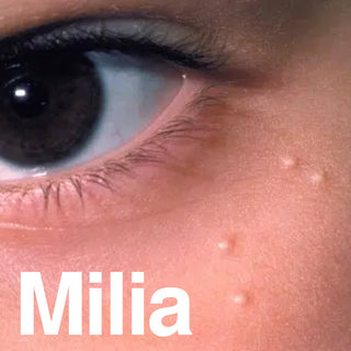 What Is Milia? How to Stop It and How to Treat It - Navinka Skincare